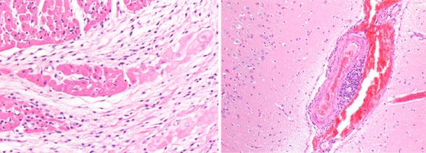 Verdickung und Stauung der Venen der rechten Hirnhälfte. Myokardium, rechter Ventrikel. Basophile, fokale Nekrose des Myokardiums mit Mikrovakuolisation.
